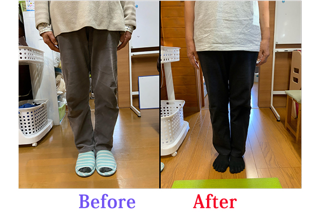 70歳代女性の膝の痛みとO脚の改善