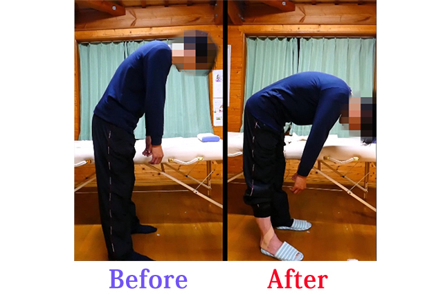 施術前後での腰痛の改善と前屈可動域