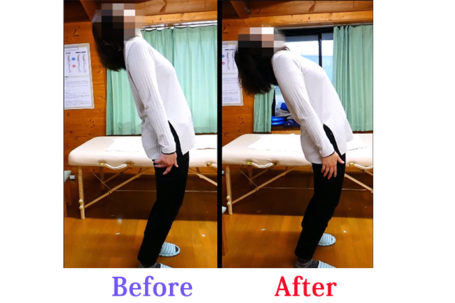 施術前後での腰痛改善と後屈可動域