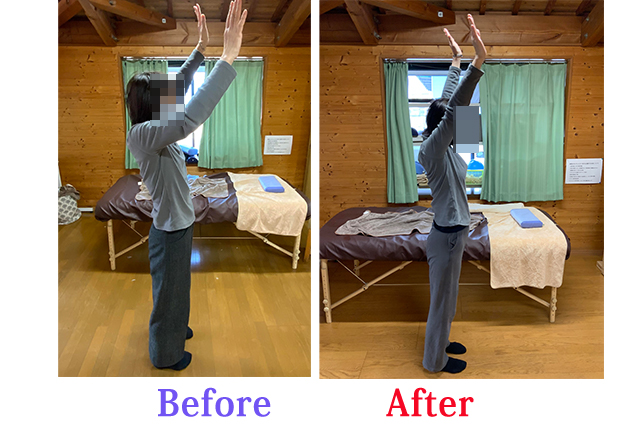 施術による肩挙上の変化